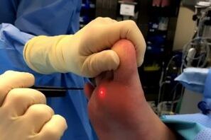 Surgical methods of wart removal