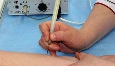 How to get rid of papillomas in the body