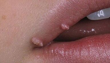 Papilloma types in humans