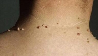 The reasons for the appearance of papillomas in the human body