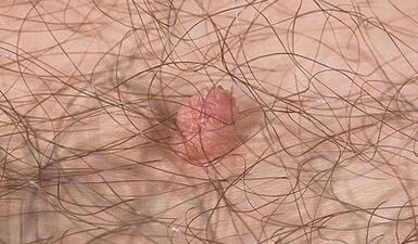Ways to transfer the human papilloma virus