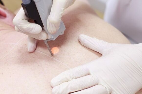 A popular method of laser papilloma removal