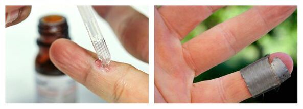 Chemical methods for the treatment of warts