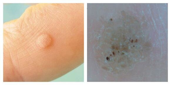 Common warts during examination and dermatoscopy