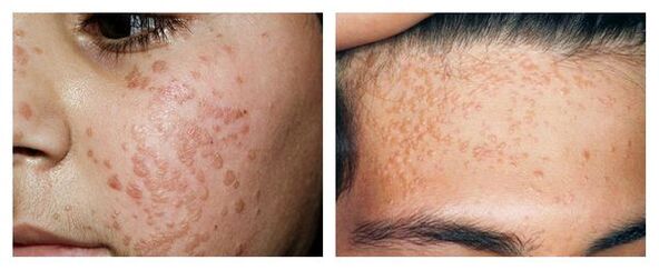 Flat warts on the face