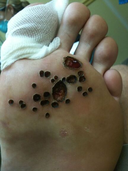 Skin after removing laser of warts in the legs