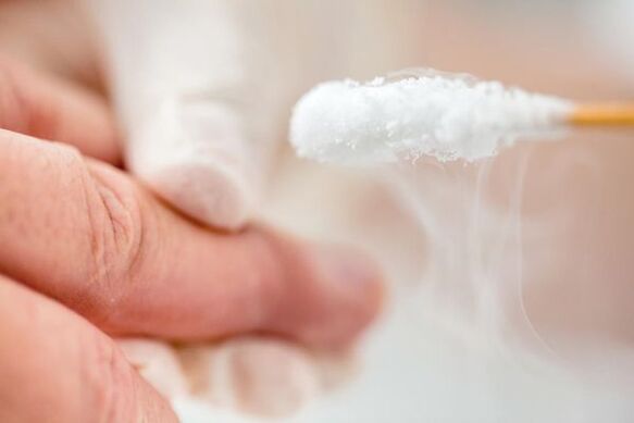 Treatment of Warty with Liquid Nitrogen