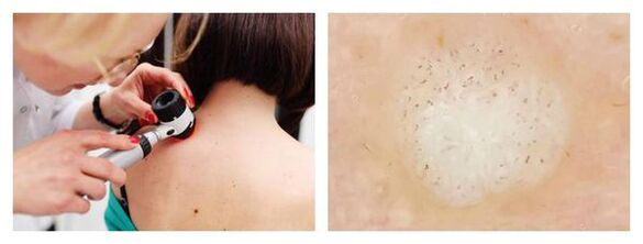 Wart dermatoscopy