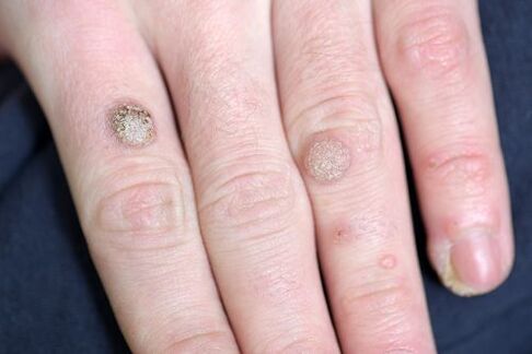Warts in the arm