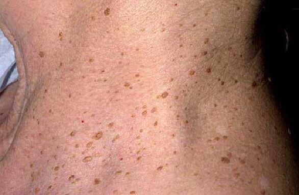 the elderly warts