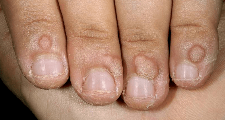 warts
