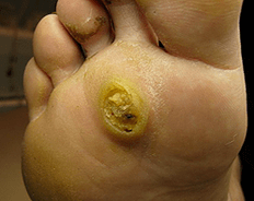 Subanary papilloma